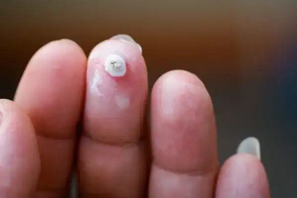Image of white wart before cryopen treatment Henley-on-Thames