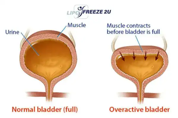 diagram of overactive bladder treatment Henley-on-Thames