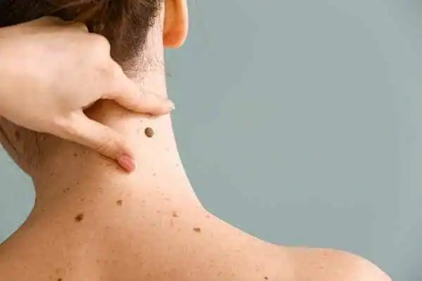 cryopen-treatment-maidenhead