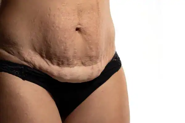 loose skin after weight loss injections Henley-on-Thames