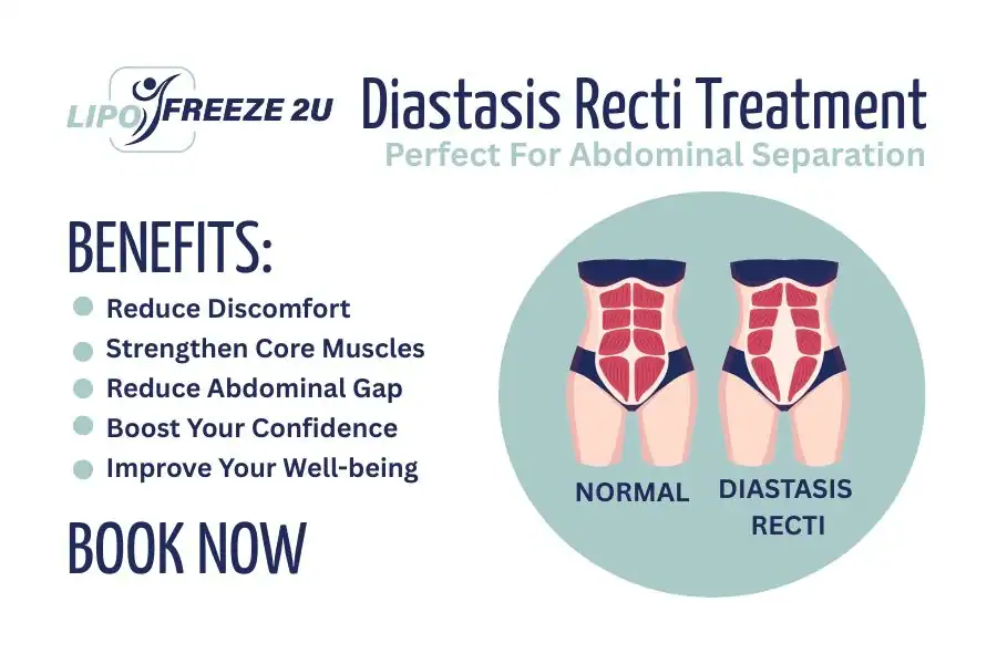 Benefits of body toning treatment Henley-on-Thames for Diastasis recti