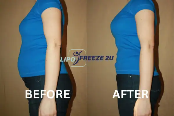 Fat freezing before and after results from Lipo Freeze2U Henley-on-Thames