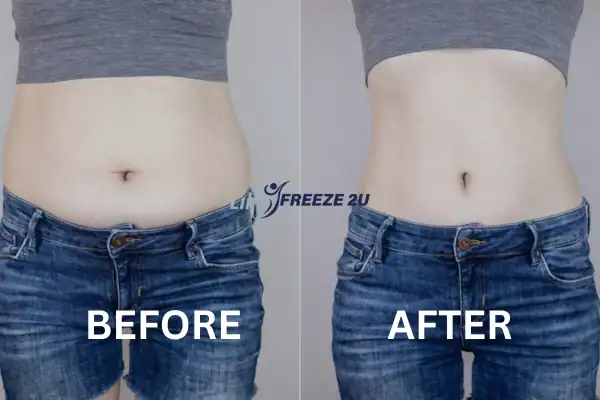 image of womans stomach before and after fat freezing treatment Henley-on-Thames Results