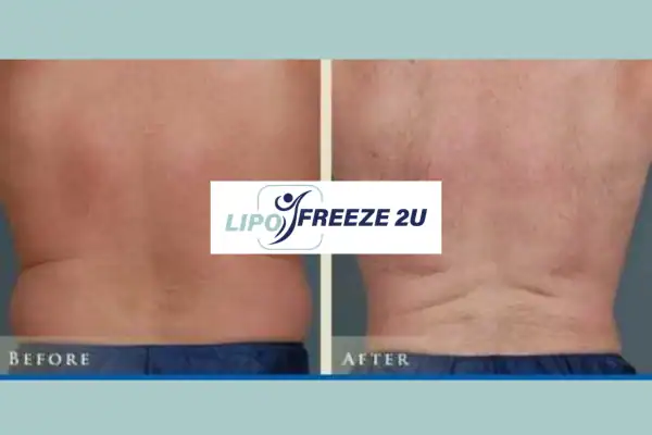 Fat freezing Henley-on-Thames before and after results for mans love handles