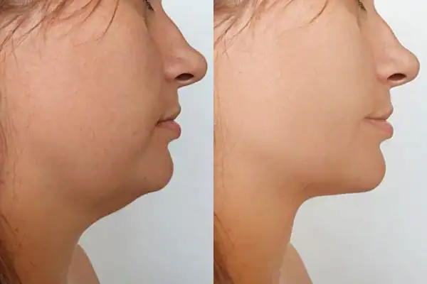 Fat dissolving injections results Henley-on-Thames