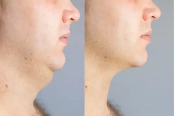 Fat dissolving injections results Henley-on-Thames