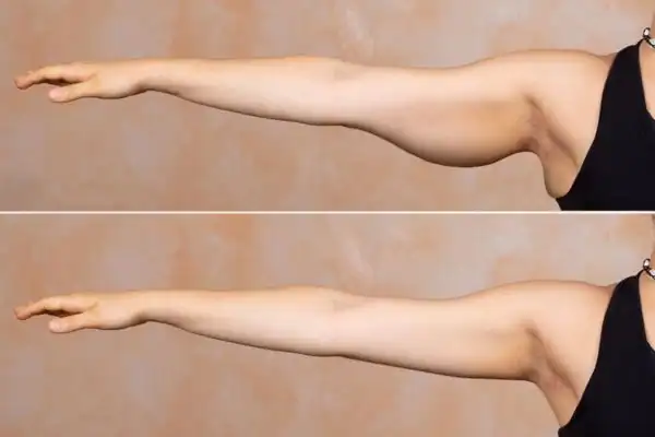 Results on the arms of fat dissolving injections Henley-on-Thames