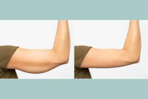 Body toning treatment Henley-on-Thames before and after results