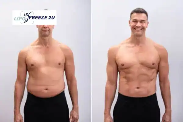 Body toning treatment Henley-on-Thames before and after results