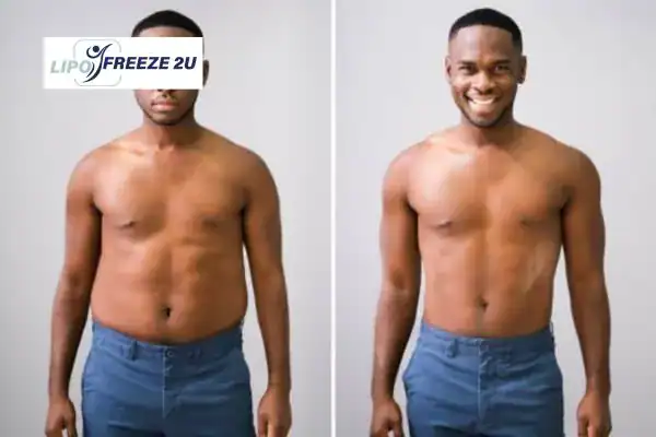 Body toning treatment Henley-on-Thames before and after results