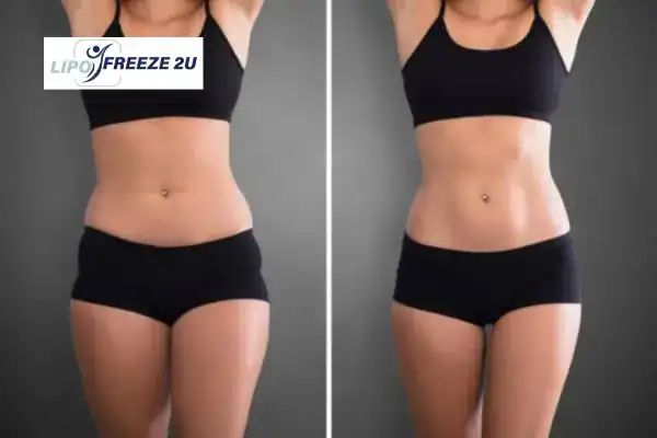 Body toning treatment Henley-on-Thames before and after results