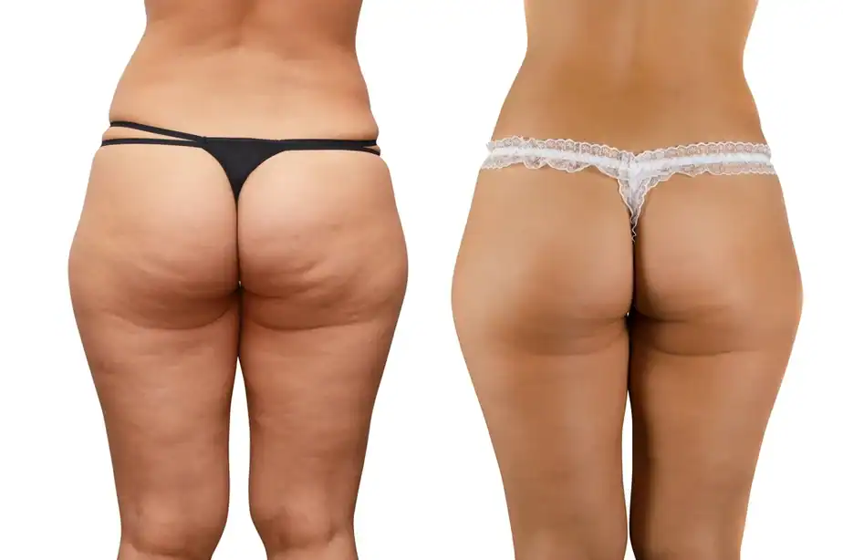 Before and after cellulite treatment Henley-on-Thames results.
