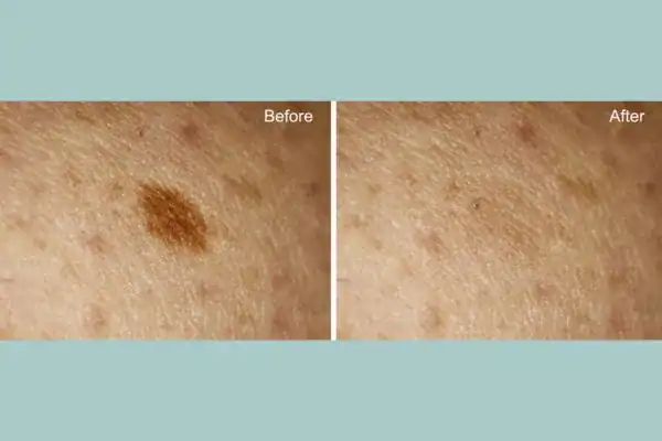 Before and after age spot removal following Cryopen Cryotherapy Treatment Henley-on-Thames
