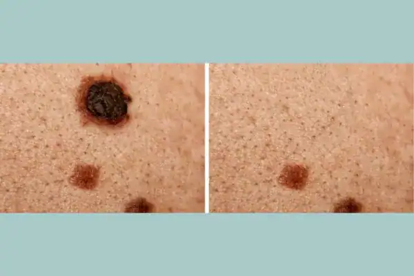 Before and after results from Cryopen Cryotherapy Treatment Henley-on-Thames