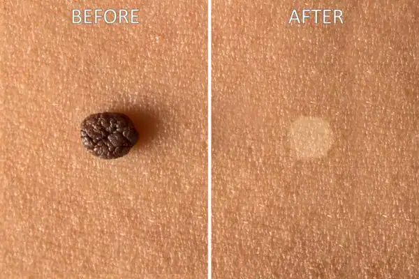 Before and after results of Cryopen Cryotherapy Treatment Henley-on-Thames