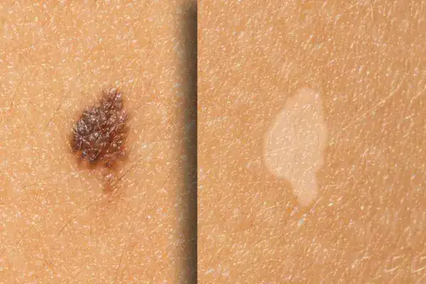 Before and after results Cryopen Cryotherapy Treatment Henley-on-Thames