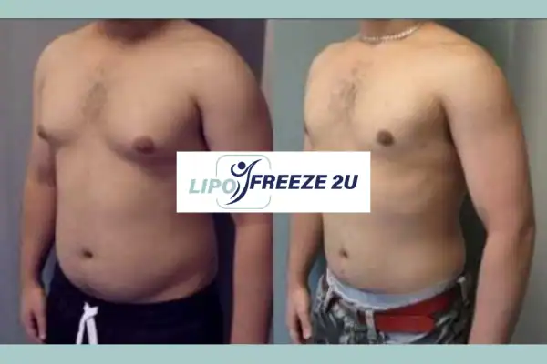 before and after results of belly toning treatment Henley-on-Thames