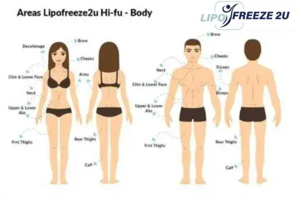 image of areas of the body and HIFU prices Henley-on-Thames