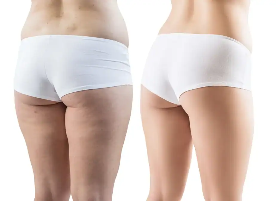 before and after Inner thighs toning treatment Henley-on-Thames results