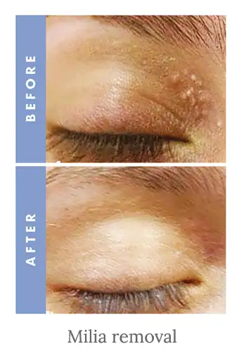 Before and after results of milia removal treatment Henley-on-Thames.