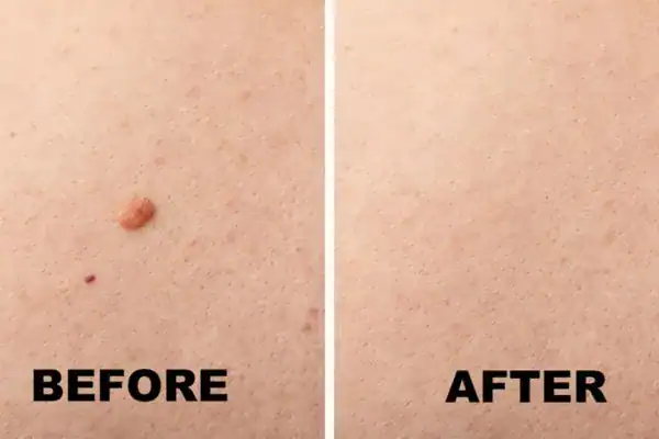 before and after mole removal Henley-on-Thames results