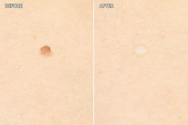mole removal Henley-on-Thames before and after results following cryopen treatment