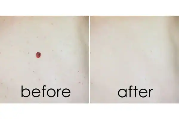 before and after mole removal Henley-on-Thames results