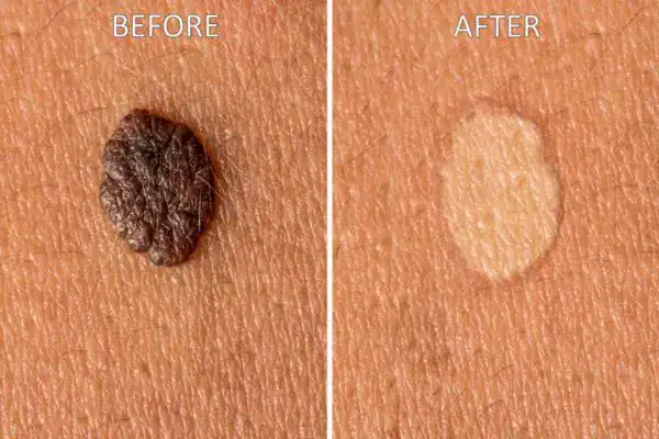 cryopen before and after results for mole removal Henley-on-Thames