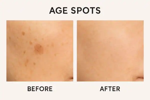 Before and after results of age spots removal Henley-on-Thames