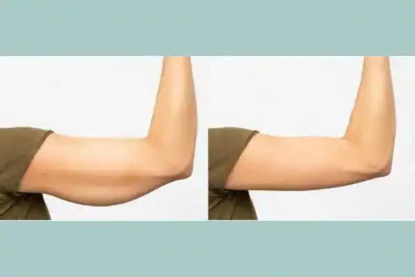 Before and after results of arm toning treatment Henley-on-Thames