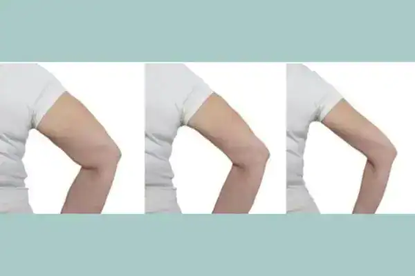 before and after results of arm toning treatment Henley-on-Thames