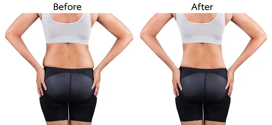 Before & After back toning treatment Henley-on-Thames