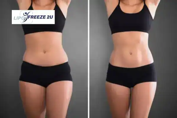 How Can LIPO FREEZE 2U Support Your Post-Pregnancy Body Recovery Henley-on-Thames?