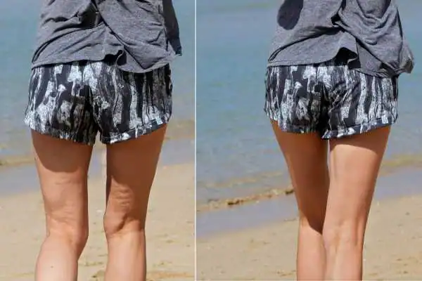 before and after results of cellulite treatment Henley-on-Thames