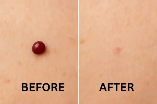 Cherry angioma removal Henley-on-Thames before and after results