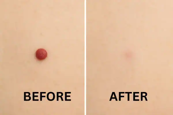 Results of before and after Cherry angioma removal Henley-on-Thames