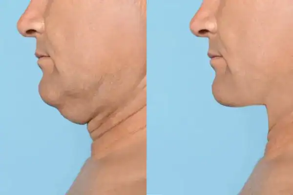 mans before and after chin toning treatment Henley-on-Thames results.