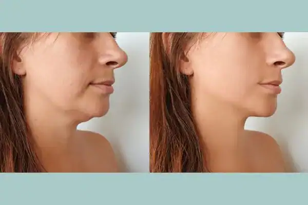 chin toning treatment 2