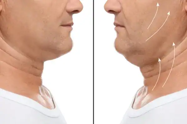 Before and after chin toning treatment Henley-on-Thames results.