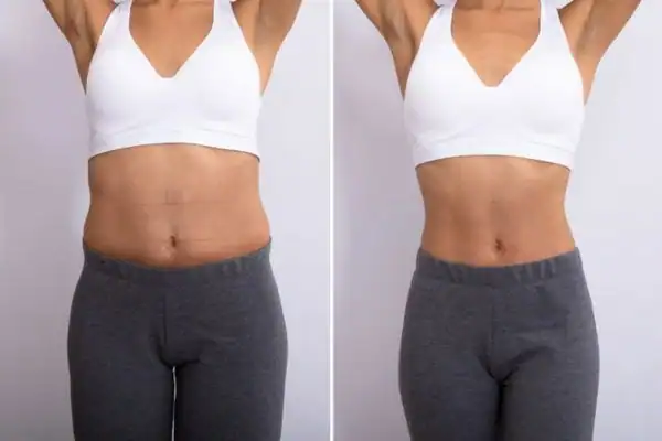 Before and after results of Hip toning treatment Henley-on-Thames