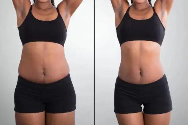 before and after hip toning treatment Henley-on-Thames