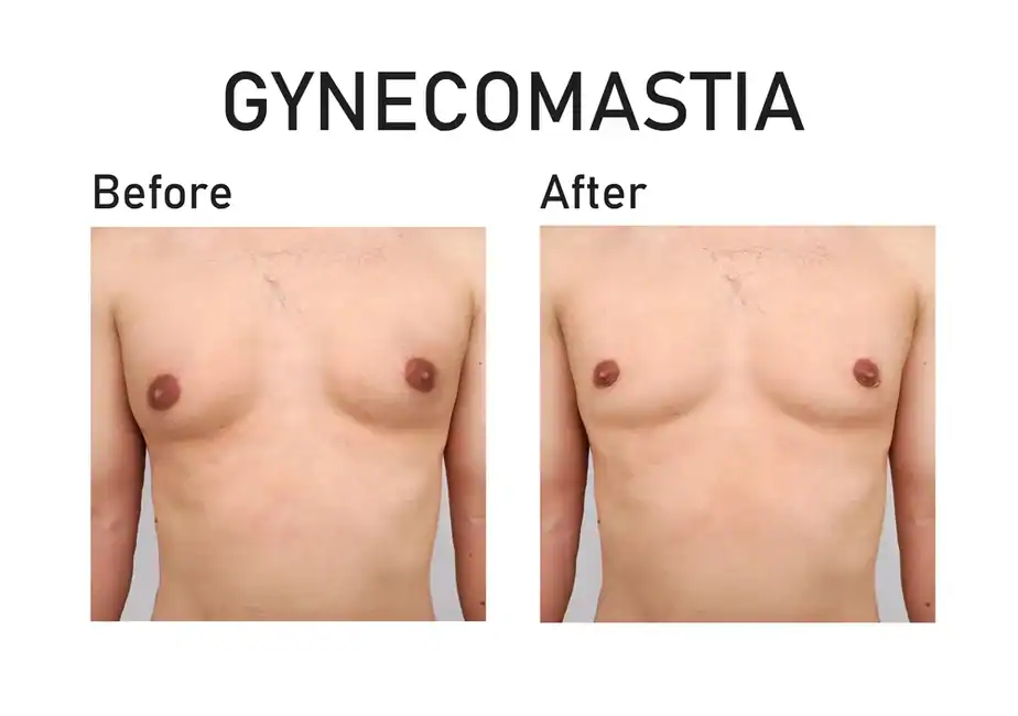 before and after man boobs treatment Henley-on-Thames