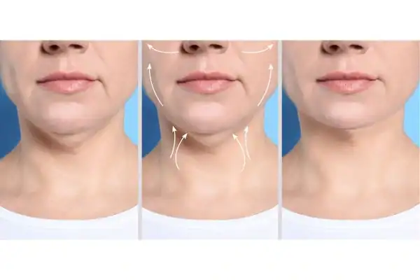 womans result of neck toning treatment Henley-on-Thames