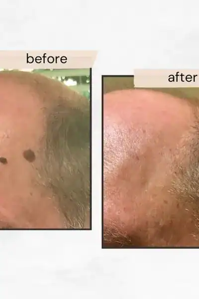Results of before and after seborrheic keratosis treatment Henley-on-Thames