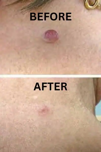 Before and after results of skin tag removal treatment Henley-on-Thames