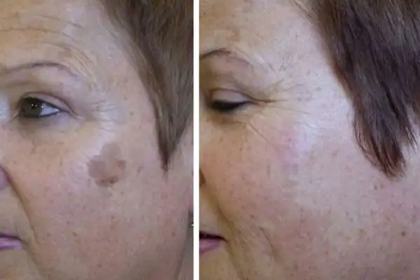 Before and after results of sun damage removal Henley-on-Thames