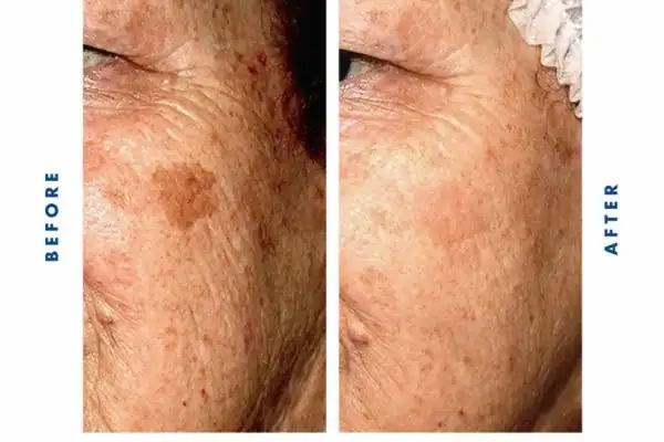 Before and after results of sun damage removal Henley-on-Thames