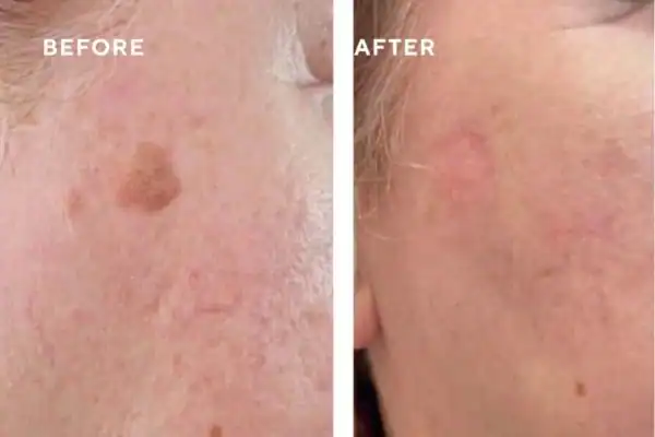 Before and after results of sun damage removal Henley-on-Thames