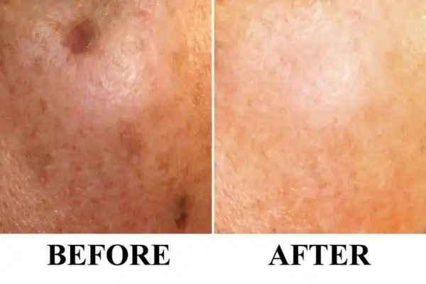 Before and after results of sun damage removal Henley-on-Thames