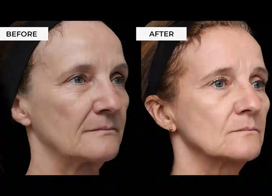 How Many RF Microneedling Sessions Will You Need to See a Difference Henley-on-Thames?